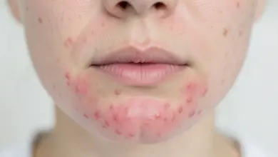 Jak léčit periorální dermatitidu a její příznaky - ilustrační foto