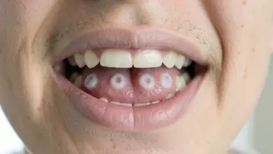 Jak léčit a předcházet aftům - ilustrační foto