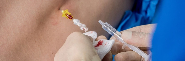 Zdravotník vkládá epidurální katétr do zadní části těla matky při porodu.