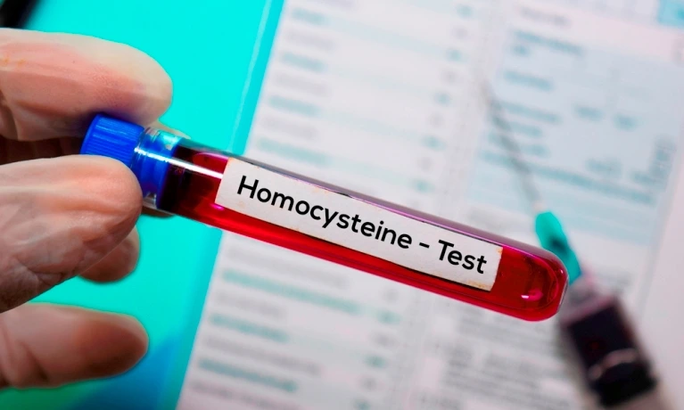 Ruka drží zkumavku s krví pro test homocysteinu.