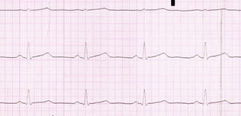 Elektrokardiogram s viditelnými vlnami srdce na mřížkovém papíru.