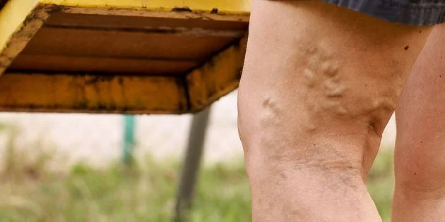 Zvětšené povrchové žíly na noze člověka venku.