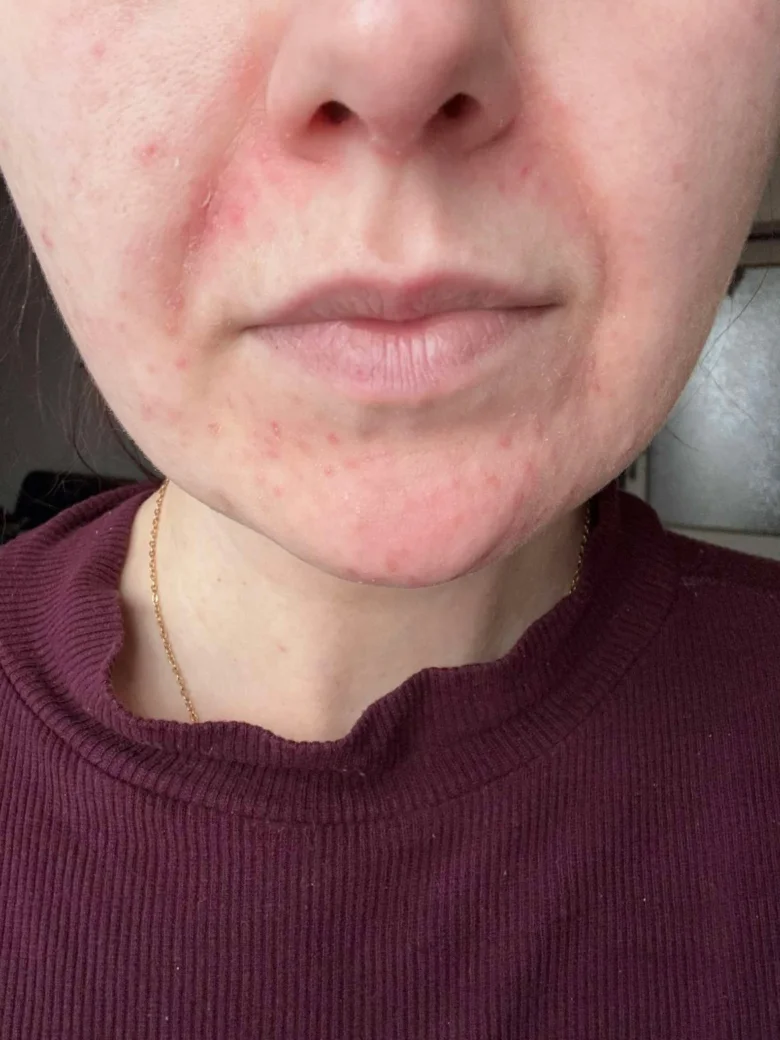 Příznaky perorální dermatitidy na tváři osoby s červenými vyrážkami kolem rtů.