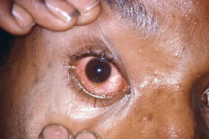 Red eye with discharge