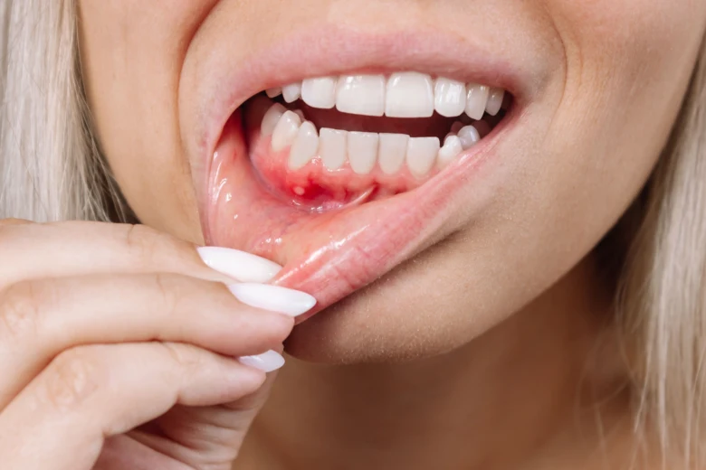 Mouth with canker sore