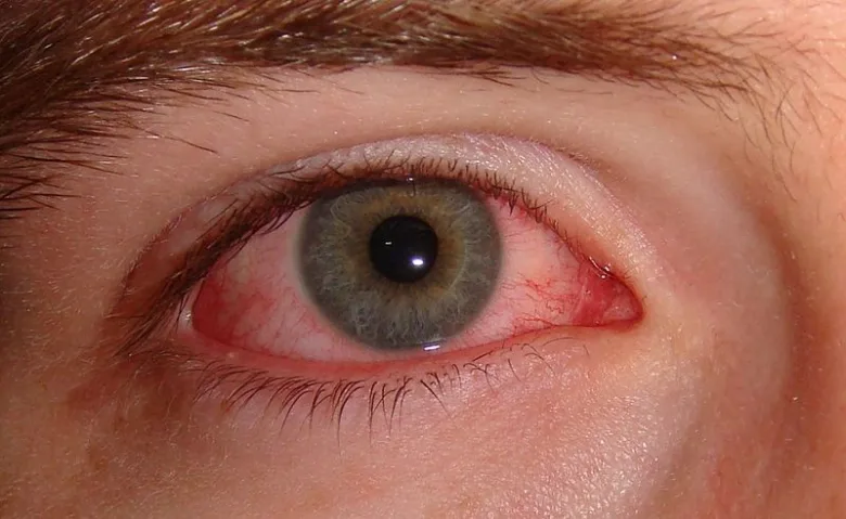 Červené oko s příznaky zánětu spojivek na fotce.