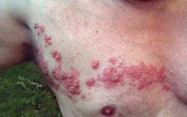 Shingles rash on chest
