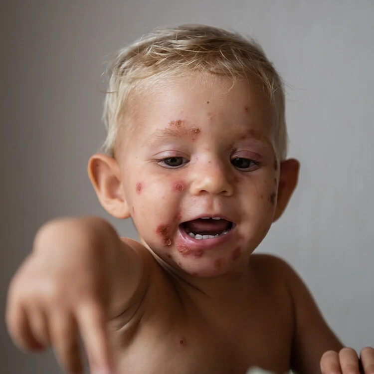 Malý dítě s červenými puchýři na obličeji způsobenými impetigem.