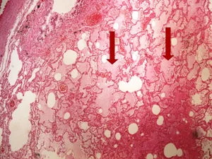 Histologický snímek plicního tkáně s příznaky edému ukazující tekutinu v alveolech.