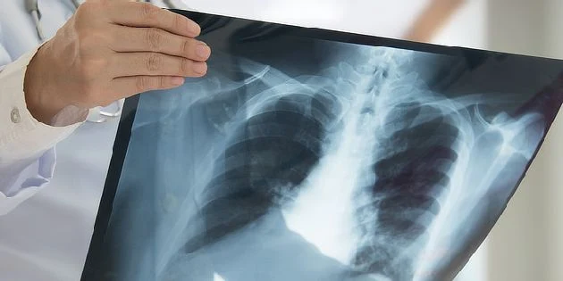 Lékař drží rentgen hrudníku pro diagnostiku plicního edému.