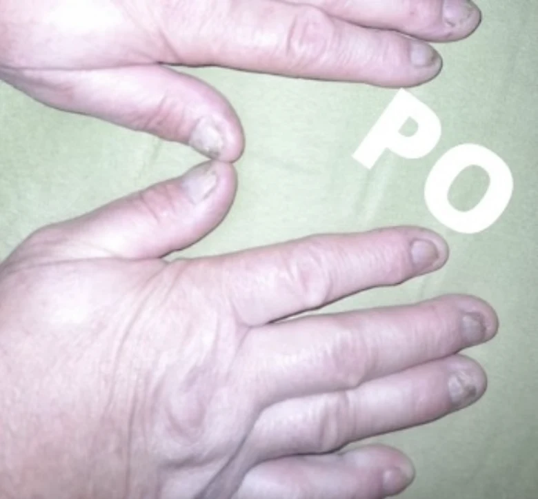 Ruce s nehy postiženými plísní pro článek o léčbě.