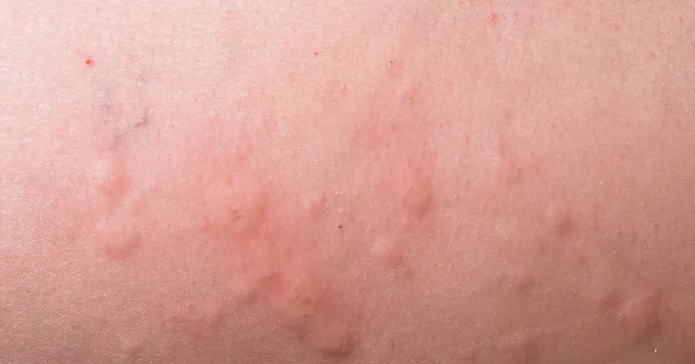 Zvýšené červené pupínky na kůži dítěte s kopřivkou.
