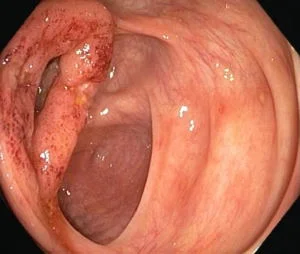Crohn's disease ulceration