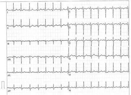 Elektrokardiografie - záznam elektrické aktivity srdce na EKG papíru.