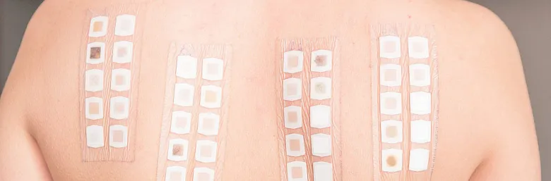 Testovací patche na zádech pro diagnostiku alergické kontaktní dermatitidy.