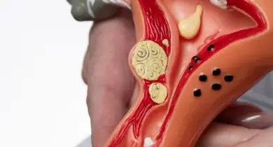 Anatomický model ukazující vnitřní orgány s několika žlutými cystickými útvary.
