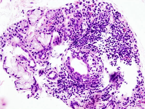 Histologický snímek s lymfocytární infiltrací typickou pro Sjögrenův syndrom.