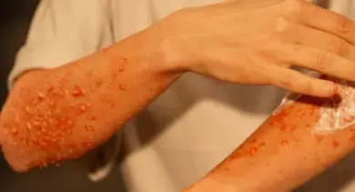 Léčení popáleniny aplikací krému na postiženou ruku.
