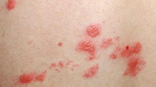 Shingles rash on skin