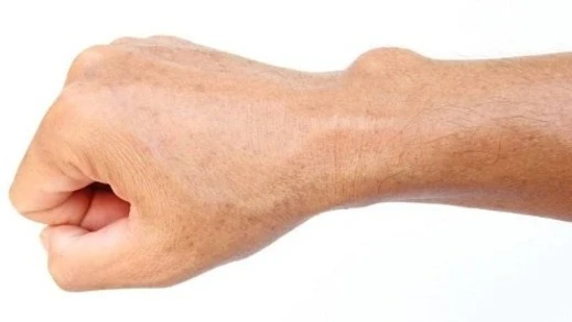 Lidská ruka s viditelným nádorem na zápěstí.
