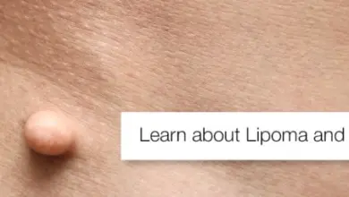 Subcutaneous lump on skin