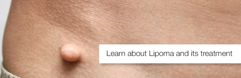 Subcutaneous lump on skin