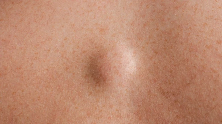 Subcutaneous lump on skin