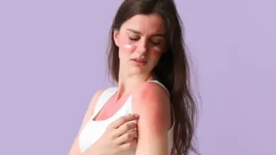 Žena s zarudlými místy na obličeji a rameni po sluneční alergii.