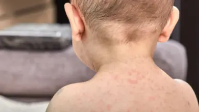 Mírné červené vyrážky na zadní straně krku dítěte s šestou dětskou nemocí.