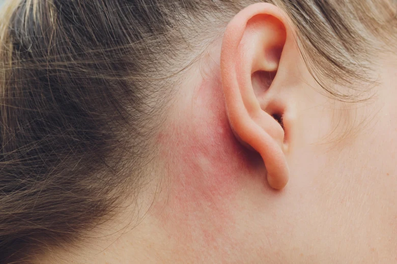 Zčervenání kůže za uchem při alergické kontaktní dermatitidě.