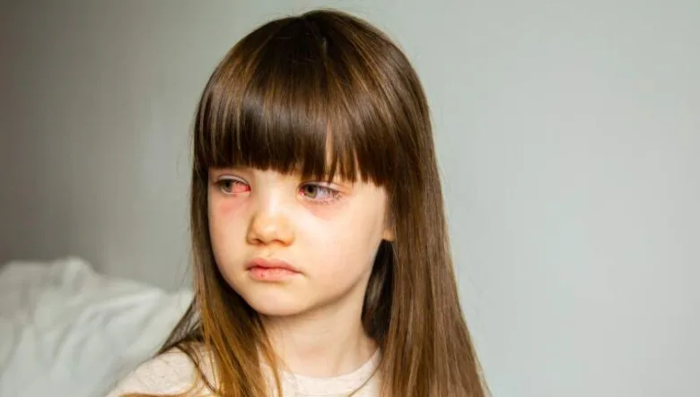 Dívka s červenými očima ukazuje příznaky zánětu spojivek.