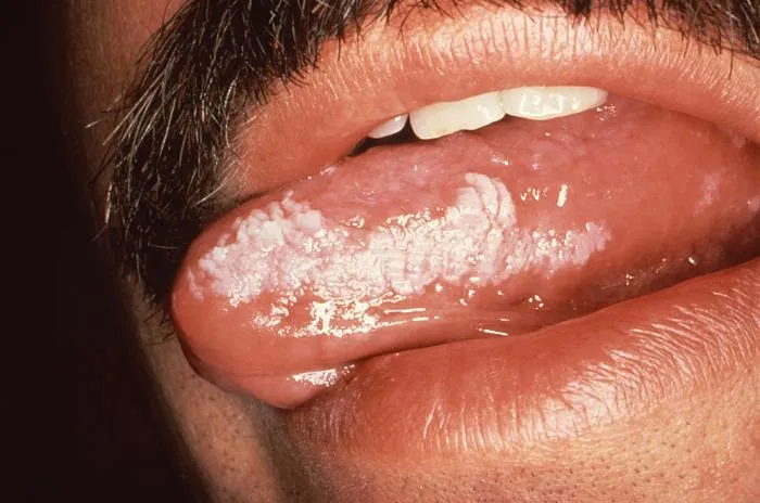 White tongue coating
