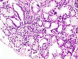 Histologický snímek slinné žlázy s zánětem při Sjögrenově syndromu