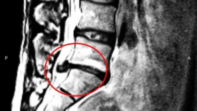 Magnetická rezonance páteře s výčnělkem ploténky označeným červeně.