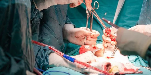 Chirurgický zákrok na vaječníku během operace rakoviny.