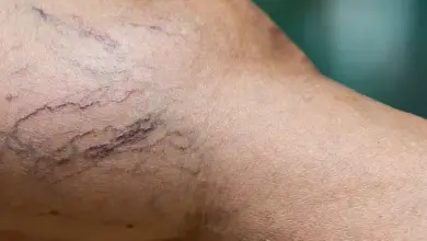 Zvětšený pohled na žilní síť v noze s viditelnými křečovými žílami.