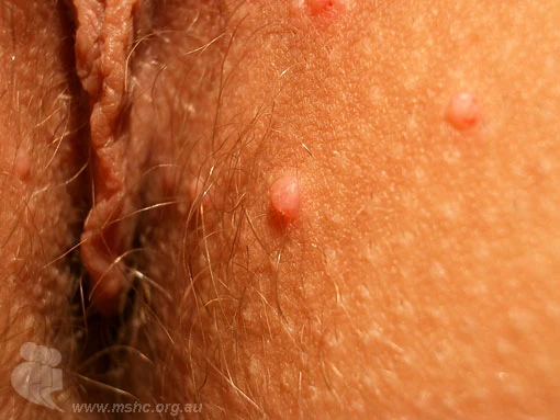 Malé hrbolky na kůži způsobené moluskem contagiosum