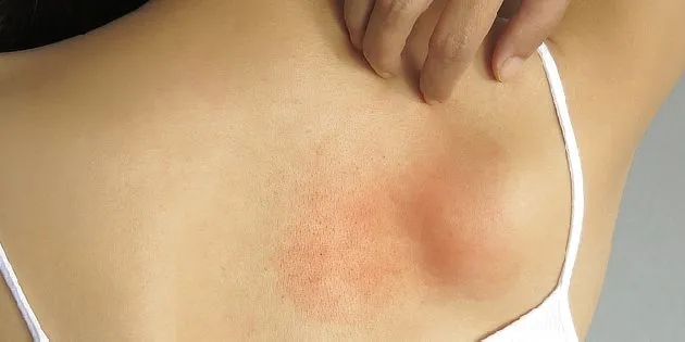 Červená vyrážka na kůži způsobená alergickou kontaktní dermatitidou.