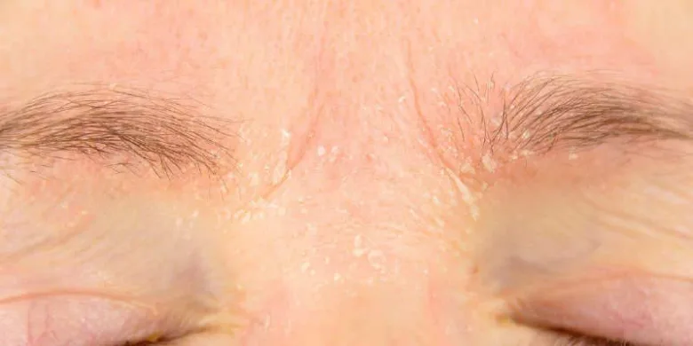 Eczema around eyes