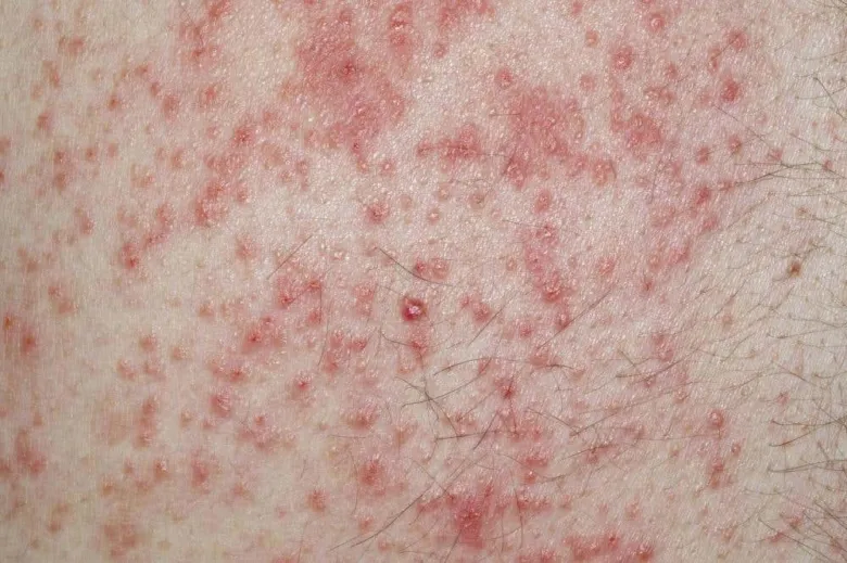Příznaky atopického ekzému na kůži s červenými skvrnami.