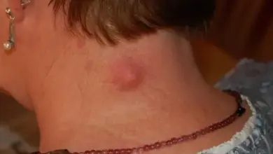 Zvětšená červená kůže na krku ukazující cystu nebo hnisavý zánět.