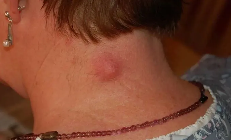 Zvětšená červená kůže na krku ukazující cystu nebo hnisavý zánět.