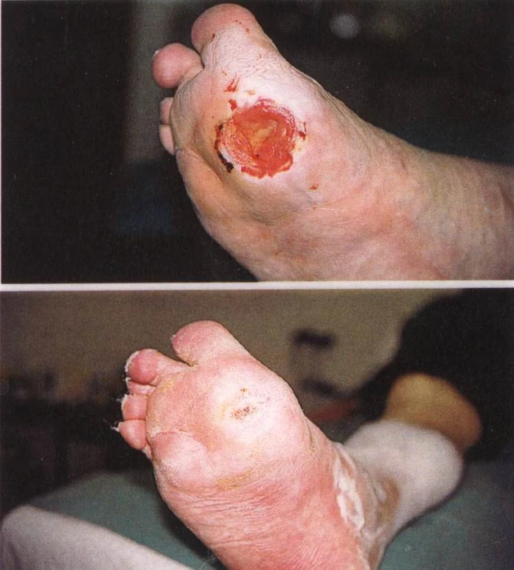 Před a po: hojení diabetického vředu na chodidle.