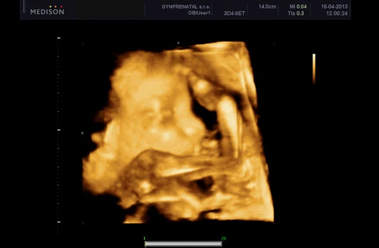 Fetal ultrasound scan